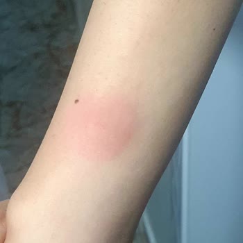 Gazikent'te Zehirli Sivrisinek Kabusu: İlaçlama Bekliyoruz