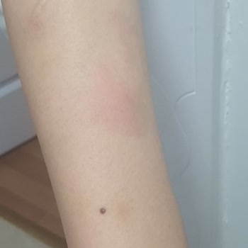 Gazikent'te Zehirli Sivrisinek Kabusu: İlaçlama Bekliyoruz