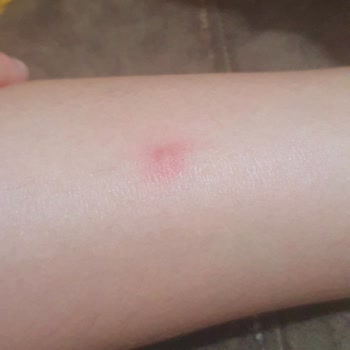 Gazikent'te Zehirli Sivrisinek Kabusu: İlaçlama Bekliyoruz