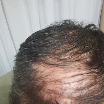 Saç Ekimi Sürecinde Hayal Kırıklığı Ve Güvensizlik