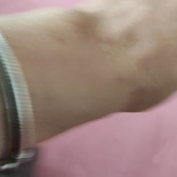 Kolonya Kullanımı Sonrası Ciltte Yanma Ve Kabarcık Sorunu