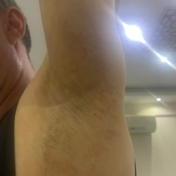 Rexona Roll On Alerji Yaptı: Açıklama Bekliyorum!