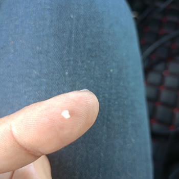 Namet Sucukta Kemik Parçası Şoku