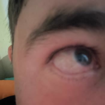 Dünya Göz Hastanesi Yanlış Tedavi Yönlendirmesi Sonucu Göz Sağlığım Tehlikeye Girdi!