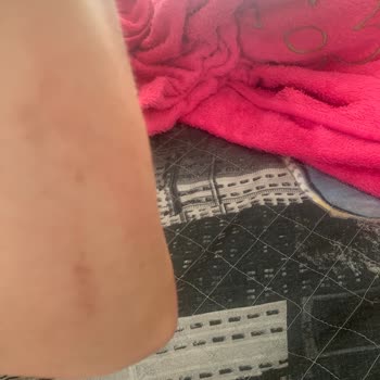 Duru Duş Jeli Alerji Sorunu