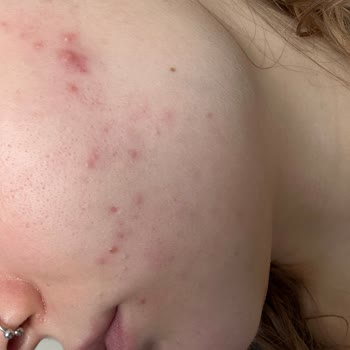 Bioderma Sebium Kerato İle Cilt Sorunları