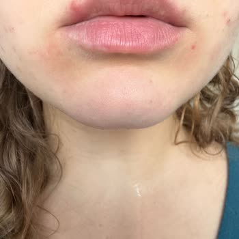 Bioderma Sebium Kerato İle Cilt Sorunları