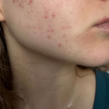 Bioderma Sebium Kerato İle Cilt Sorunları