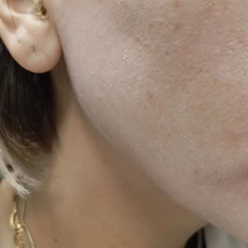 Solante Pregna Güneş Kremi İle Yaşadığım Sorunlar