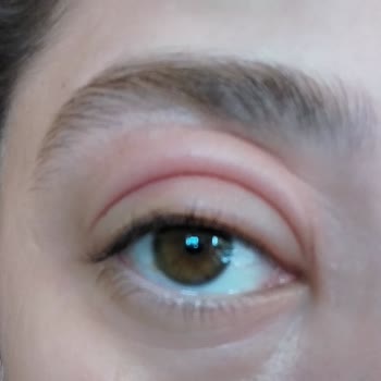 Göz Altı Serumu Kaşıntı Ve Şişlik Yaptı, Düzeltme Yok!