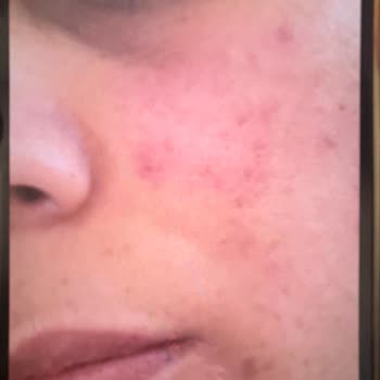 Sesu Krem Kullanımı Sonrası Cilt Yanıkları Ve Lekeler