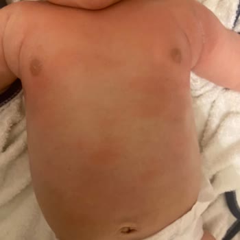 Bebekte Alerji Yapan Mustela Stelatopia Krem