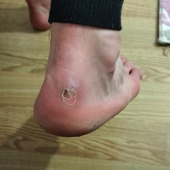 Lumberjack Ayakkabı Ayağımı Mahvetti