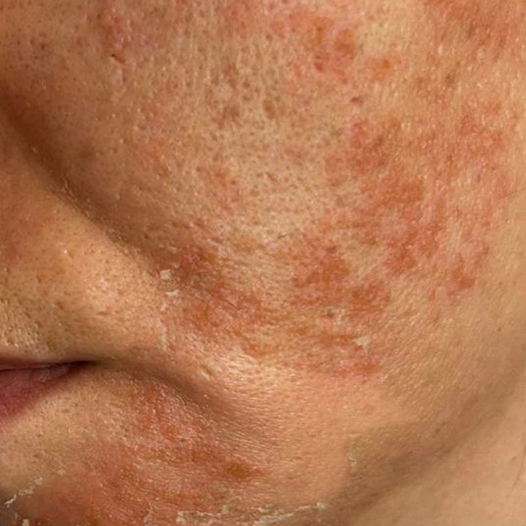 Yanlış Yöntemlerle Cilt Sorunları Ve İade Mücadelesi