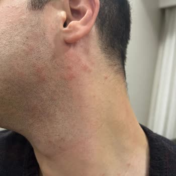 Bargello Parfüm Alerjisi: Yüzümde İzler Ve Şüpheli Ürün