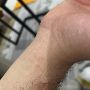 Bargello Parfüm Alerjisi: Yüzümde İzler Ve Şüpheli Ürün