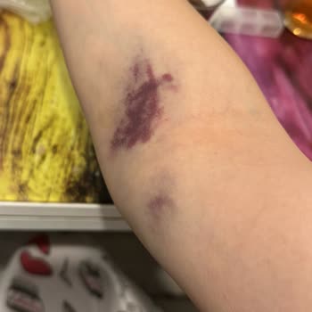 Hastanede Damar Yolu Açma Sorunu Ve Yetersiz Hemşirelik Hizmeti