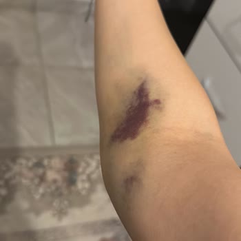 Hastanede Damar Yolu Açma Sorunu Ve Yetersiz Hemşirelik Hizmeti