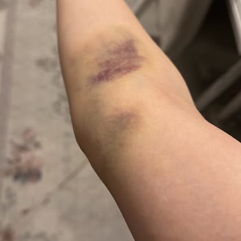 Hastanede Damar Yolu Açma Sorunu Ve Yetersiz Hemşirelik Hizmeti