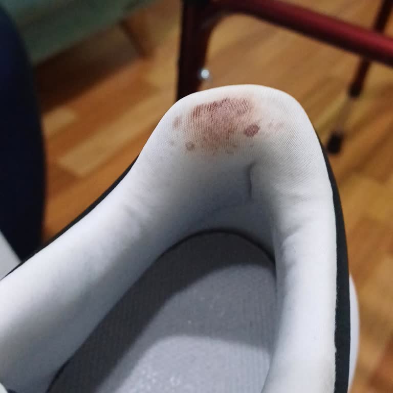 Adidas Ayakkabı Topuk Sorunu Ve İade Problemi