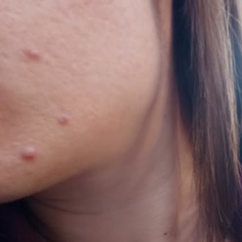 Bioderma Güneş Kremi Cildimde Sivilce Ve Leke Yaptı!