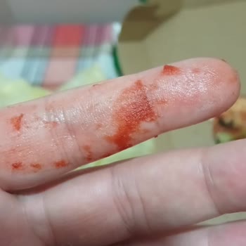 Cam Parçası İçeren Pizza: Hayati Tehlike Ve Acil Çözüm Talebi