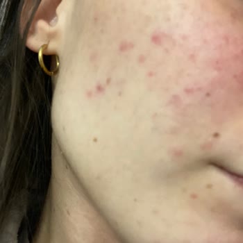 Bioderma Sebium Foaming Gel Kullanımı Sonrası Cilt Sorunları