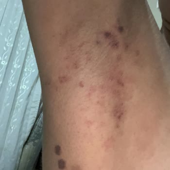 Lazer İşleminde Beklenmedik Yanık Ve İz Sorunu