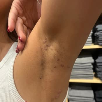 Lazer İşleminde Beklenmedik Yanık Ve İz Sorunu