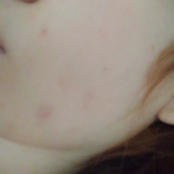 Cerave Cleanser for Acne-Prone Skin Caused Severe Breakouts Instead of Helping