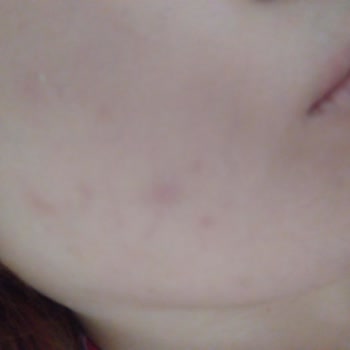 Cerave Cleanser for Acne-Prone Skin Caused Severe Breakouts Instead of Helping