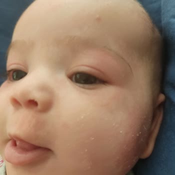 Bebek Yağı Kullanımı Sonrası Cilt Reaksiyonu