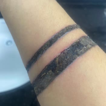 Dövme Silme Uzmanı (dovmesilmeuzmani.com) Yanlış Tedavi Sonrası Cilt Sorunları!