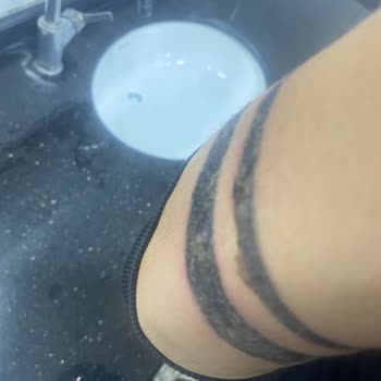 Dövme Silme Uzmanı (dovmesilmeuzmani.com) Yanlış Tedavi Sonrası Cilt Sorunları!