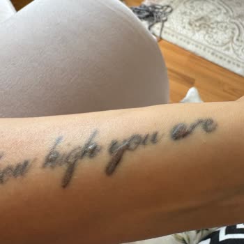 Dövme Silme Uzmanı (dovmesilmeuzmani.com) Yanlış Tedavi Sonrası Cilt Sorunları!