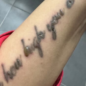 Dövme Silme Uzmanı (dovmesilmeuzmani.com) Yanlış Tedavi Sonrası Cilt Sorunları!