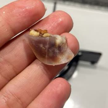 Kuruyemişteki Cam Tehlikesi: Acil Servis Yolculuğu