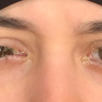 Göz Nemlendiricisi Kullanımı Sonrası Ciddi Alerjik Reaksiyon