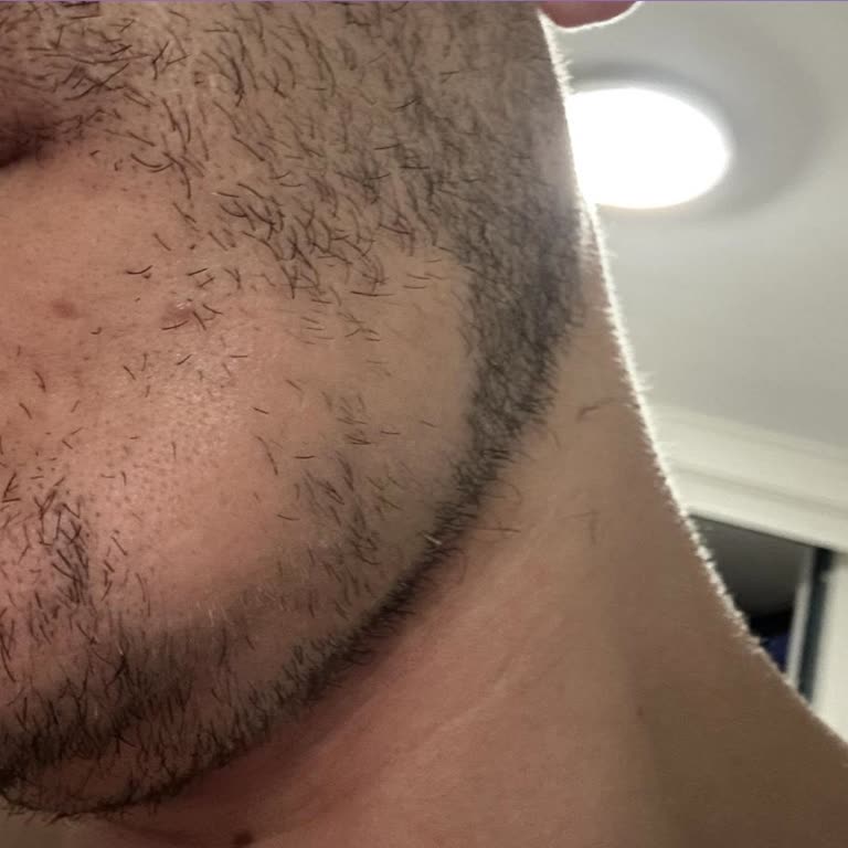 Hafız Dede Saçkıran Tedavisi Faydasız