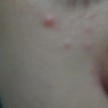 Nivea Cilt Ürünü Sivilce Sorununu Artırdı