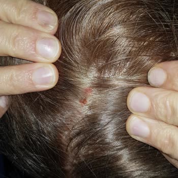 Saç Boyası Kullanımı Sonrası Cilt Yanığı Ve Pişmanlık