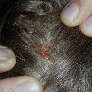 Saç Boyası Kullanımı Sonrası Cilt Yanığı Ve Pişmanlık