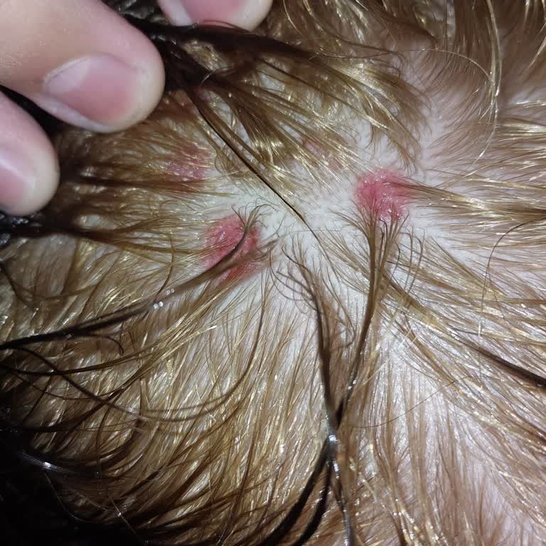 Saç Boyası Sonrası Ciltte Oluşan Yaralar