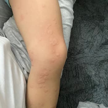 Dalin Bebek Şampuanı Alerjik Reaksiyona Sebep Oldu!