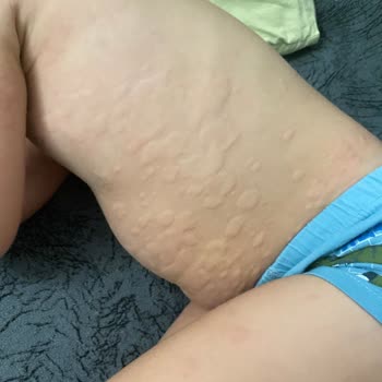 Dalin Bebek Şampuanı Alerjik Reaksiyona Sebep Oldu!