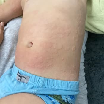 Dalin Bebek Şampuanı Alerjik Reaksiyona Sebep Oldu!