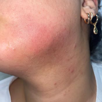 Güneş Kremi Yüzümü Tahriş Etti