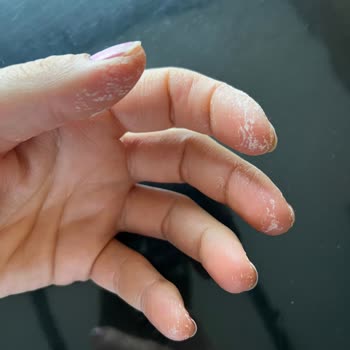 Yanlış Yönlendirme: Cilt Yanığı Tehlikesi