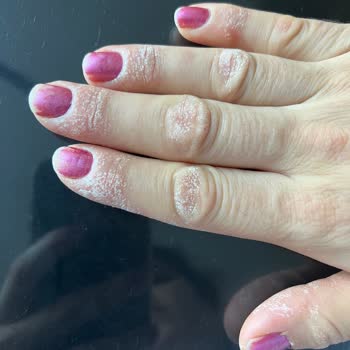 Yanlış Yönlendirme: Cilt Yanığı Tehlikesi