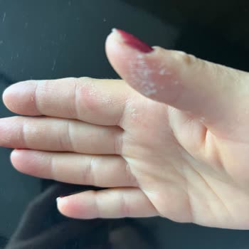 Yanlış Yönlendirme: Cilt Yanığı Tehlikesi